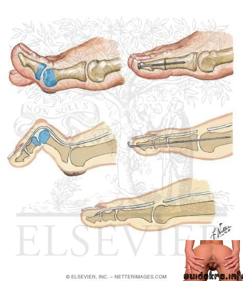 toe deformities surgery procedures